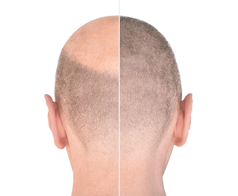 głowa przed i po mikropigmentacji